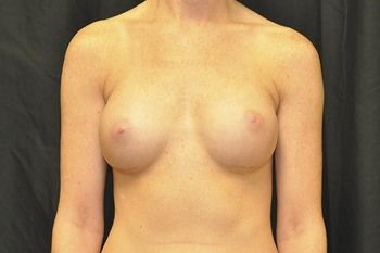 Breast Augmentation before and after - after