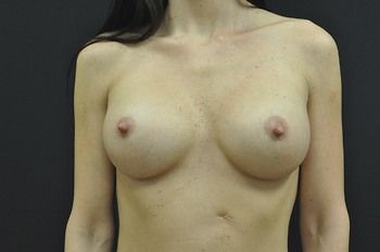 Breast Augmentation before and after - after
