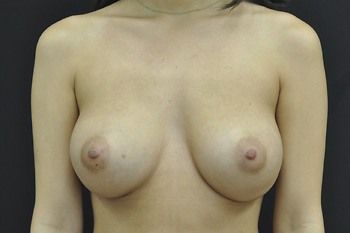 Breast Augmentation before and after - after
