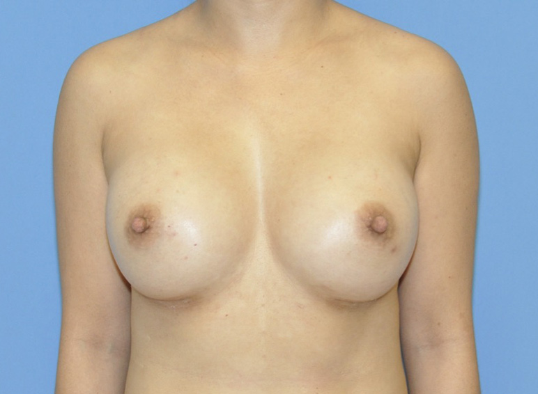 Breast Augmentation by Dr. Andrew Smith — after
