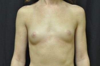 Breast Augmentation by Dr. Andrew Smith — before and after