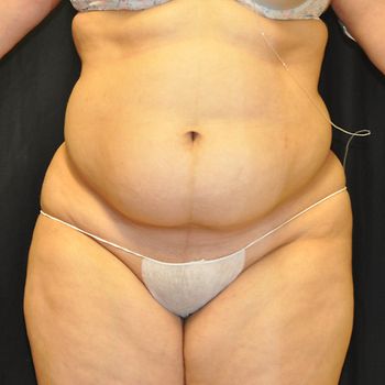 Liposuction before and after - before