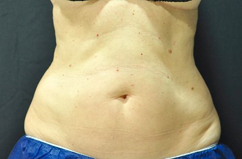 Procedure before and after - before