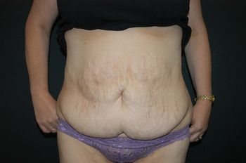 Tummy Tuck before and after - before