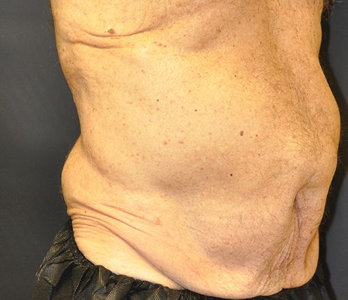 Tummy Tuck before and after - before