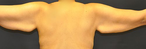 Procedure before and after - before