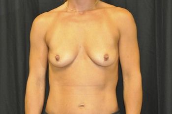 Breast Augmentation before and after - before