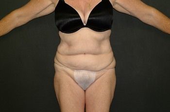 Tummy Tuck before and after - before