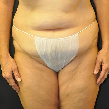 Tummy Tuck before and after - before