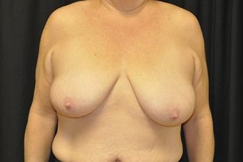 Breast Lift by Dr. Andrew Smith — before and after