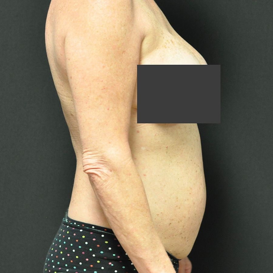 Liposuction before and after - before