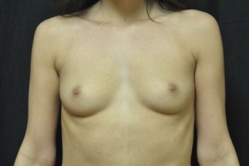Breast Augmentation before and after - before