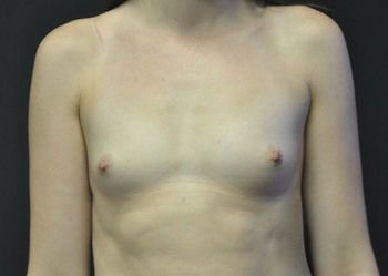 Breast Augmentation before and after - before