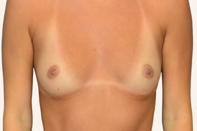 Breast Augmentation before and after - before