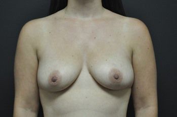 Breast Augmentation before and after - before