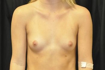 Breast Augmentation before and after - before