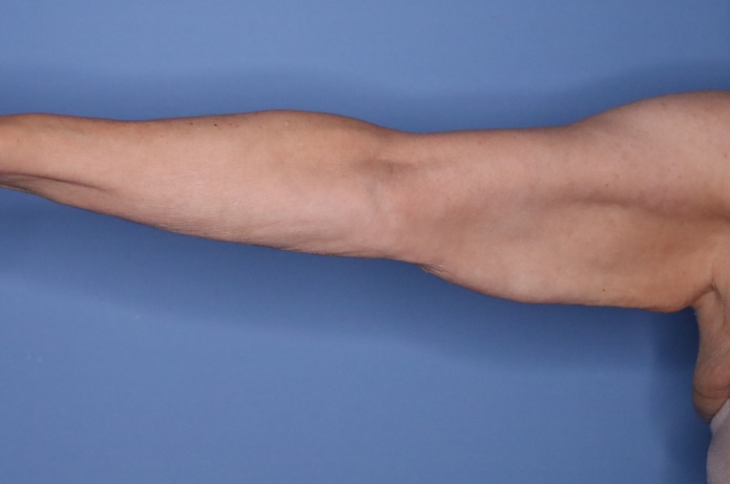 Arm Lift before and after - before