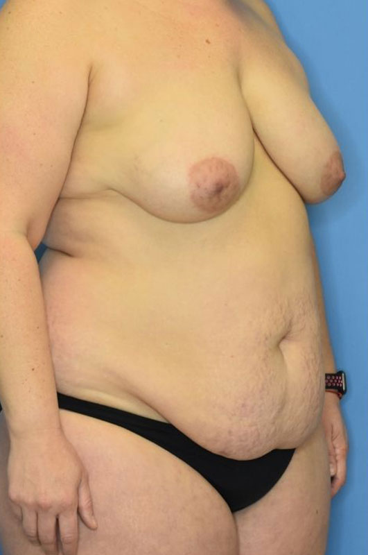 Mommy Makeover before and after - before