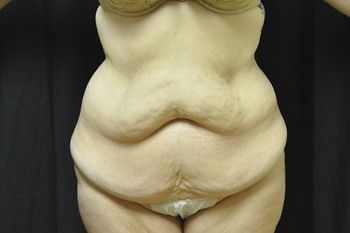 Tummy Tuck before and after - before
