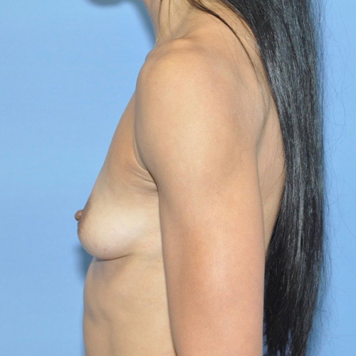 Breast Augmentation by Dr. Andrew Smith — before