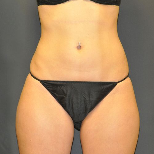 Procedure before and after - before