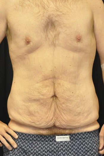 Tummy Tuck before and after - before