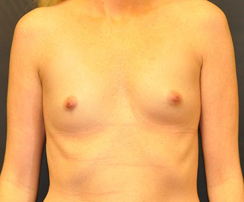 Breast Augmentation before and after - before