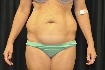 Tummy Tuck before and after - before