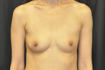 Breast Augmentation before and after - before