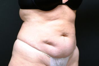 Tummy Tuck before and after - before