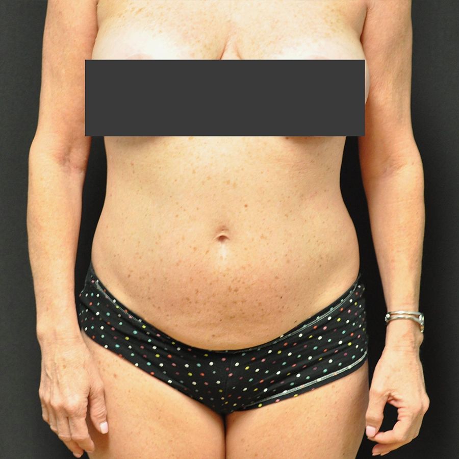 Liposuction before and after - before