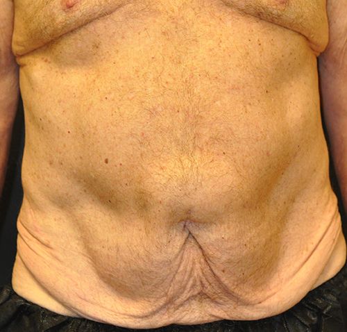 Tummy Tuck before and after - before