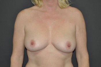 Breast Lift by Dr. Andrew Smith — before and after