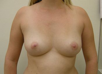 Breast Augmentation before and after - before