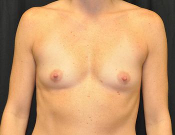 Breast Augmentation by Dr. Andrew Smith — before and after