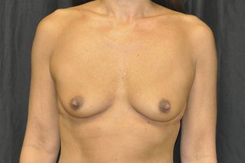 Breast Augmentation before and after - before