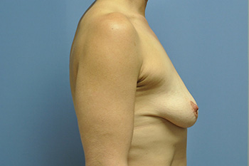 Breast Lift by Dr. Andrew Smith — before and after