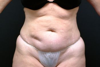 Tummy Tuck before and after - before