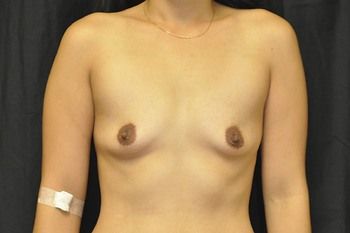Breast Augmentation before and after - before