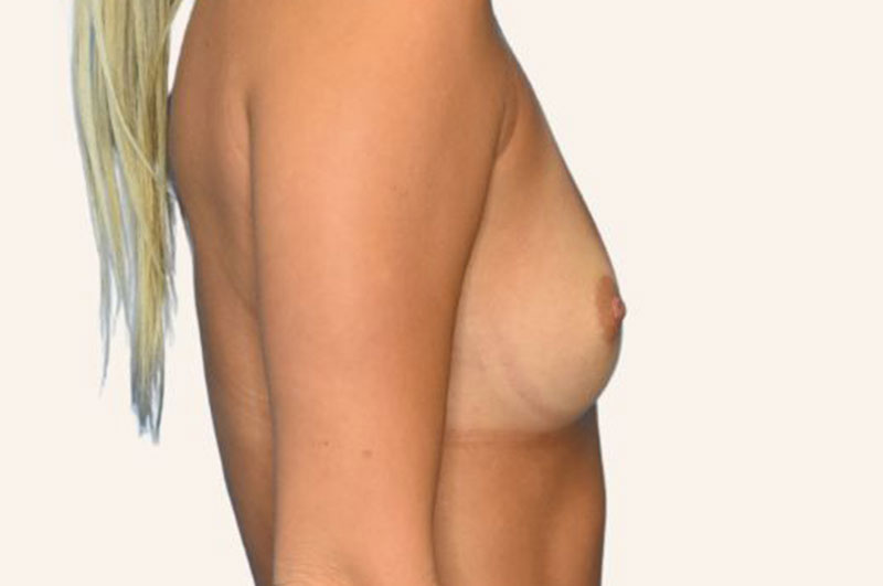 Breast Augmentation before and after - before