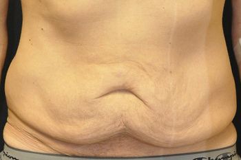 Tummy Tuck before and after - before