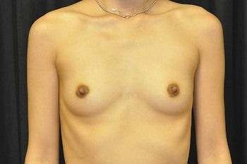 Breast Augmentation before and after - before