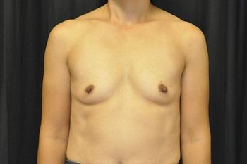 Breast Augmentation by Dr. Andrew Smith — before and after