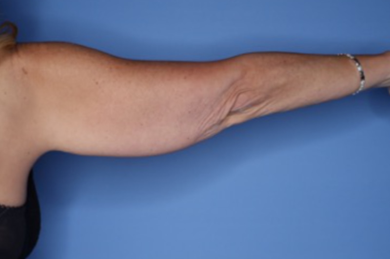 Arm Lift before and after - before