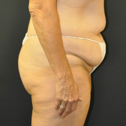 Tummy Tuck before and after - before