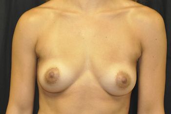 Breast Augmentation before and after - before