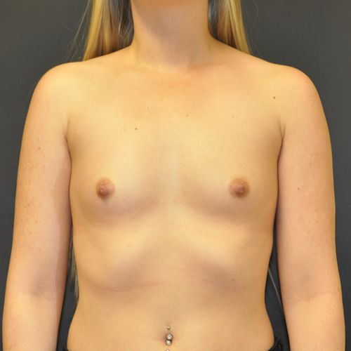 Breast Augmentation before and after - before