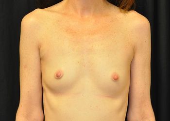 Breast Augmentation by Dr. Andrew Smith — before