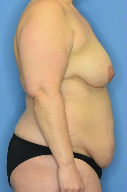Mommy Makeover before and after - before