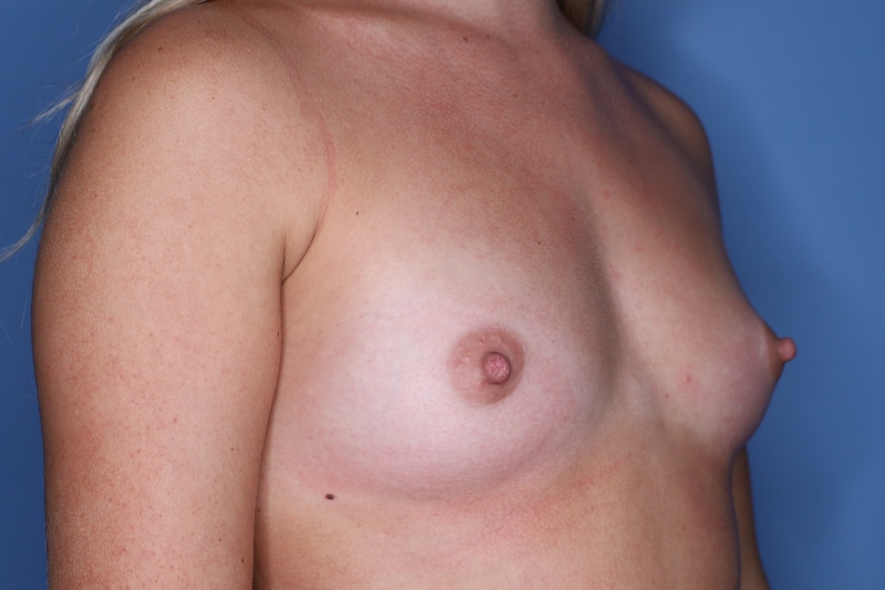 Breast Augmentation before and after - before